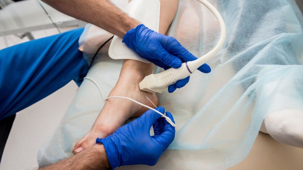 Radiofrequency ablation