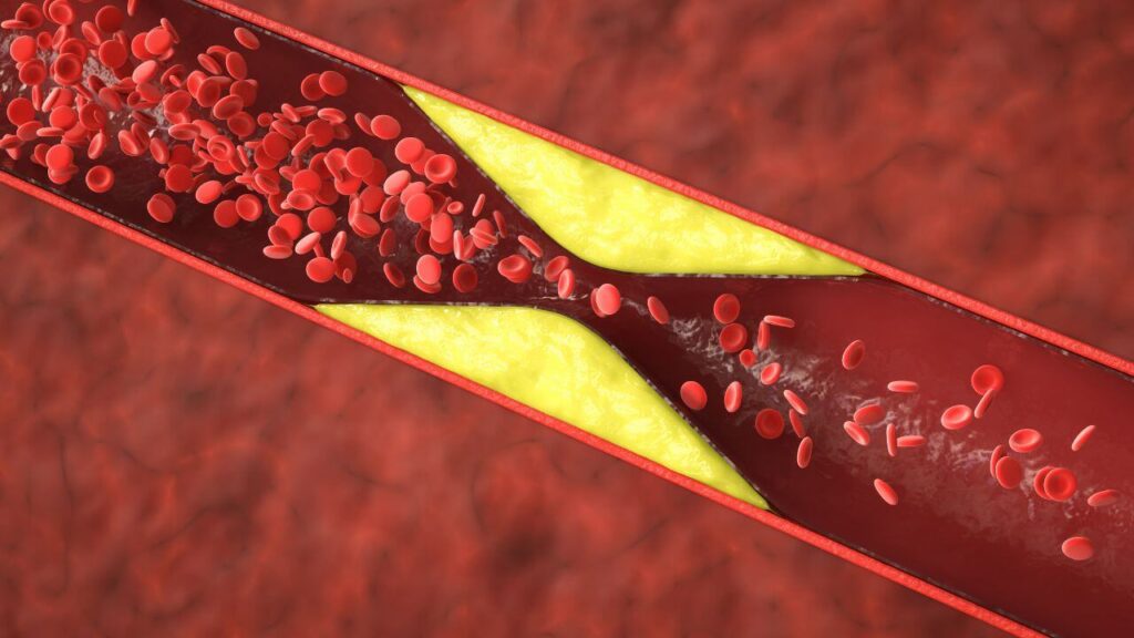 Peripheral artery disease illustration