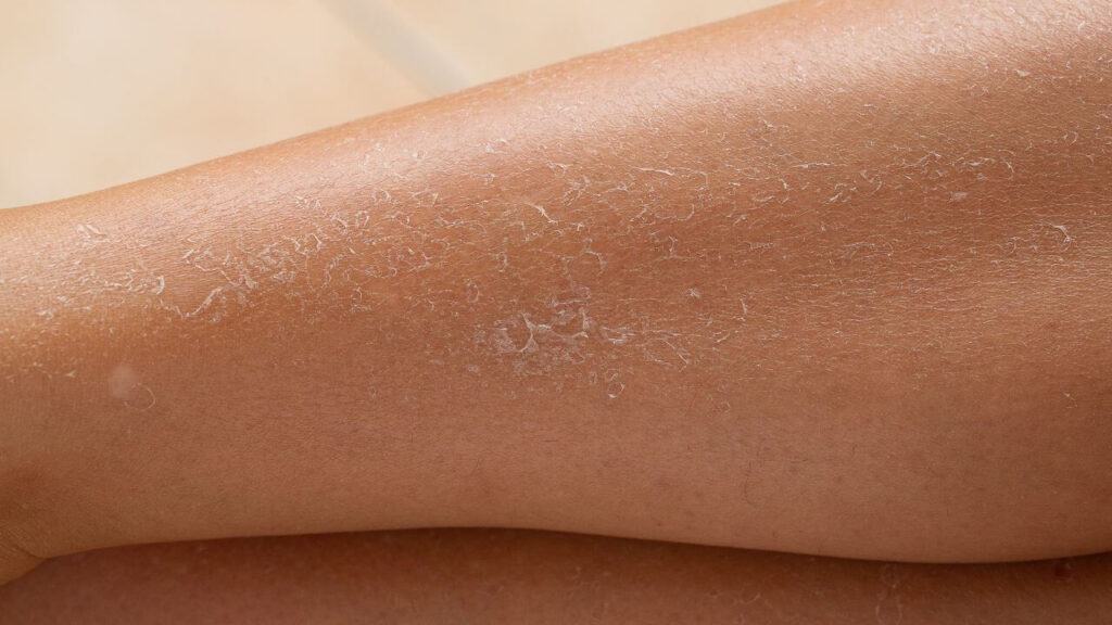 Dry skin in legs