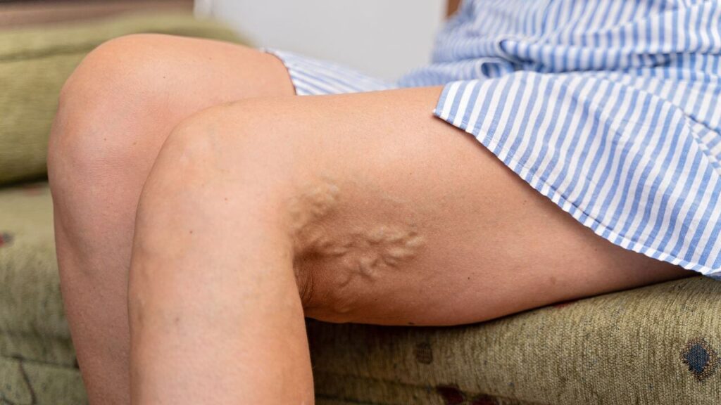 A leg with varicose veins