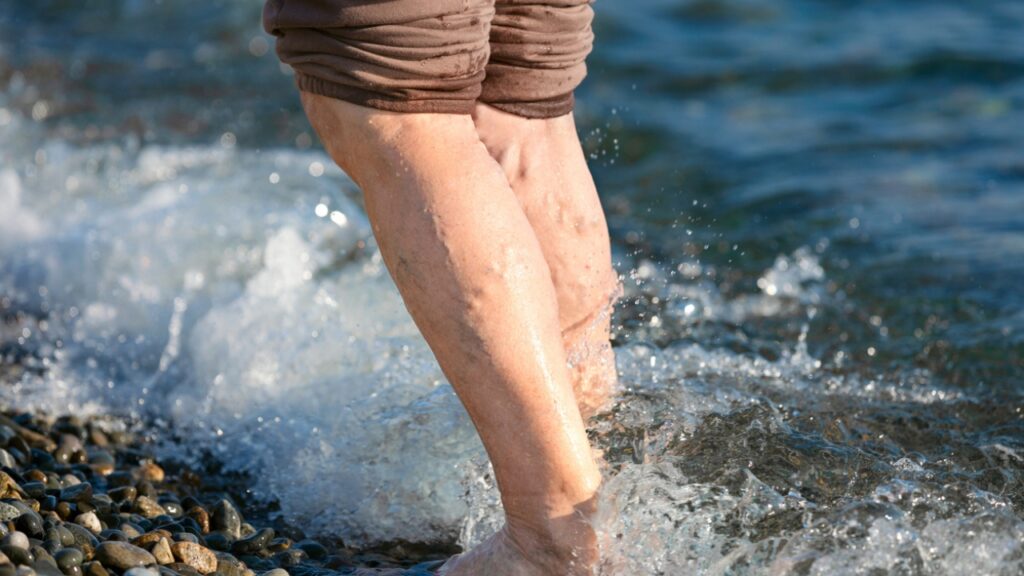 Legs with varicose veins