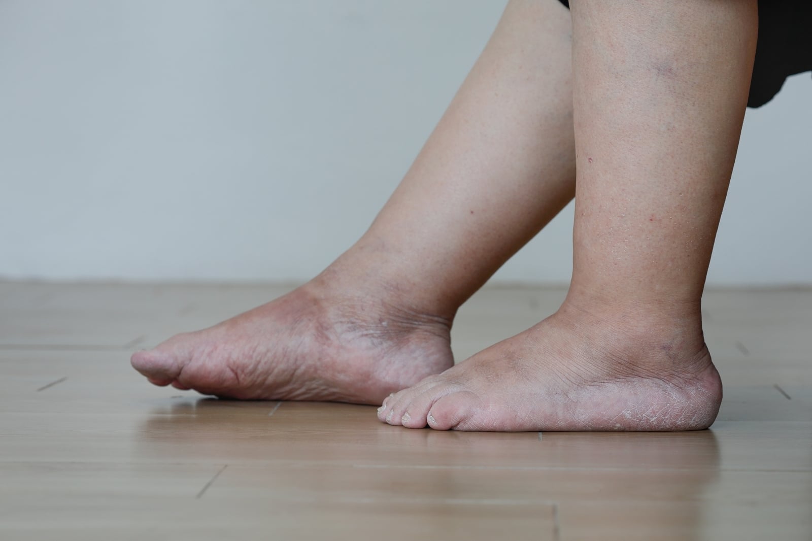 Swelling Legs