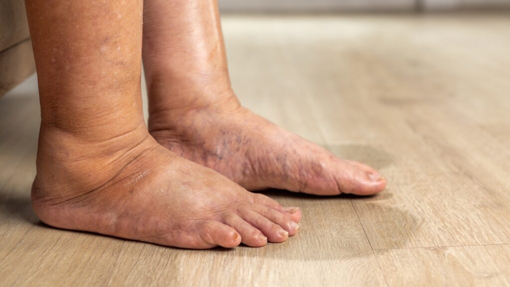 Swelling legs