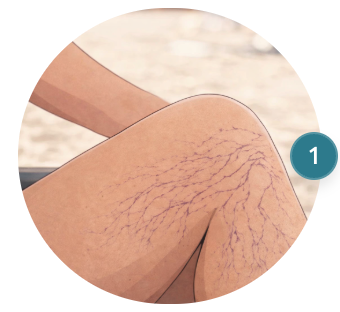 Spider Veins