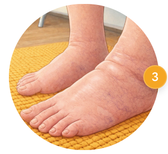 Swelling Legs & Edema