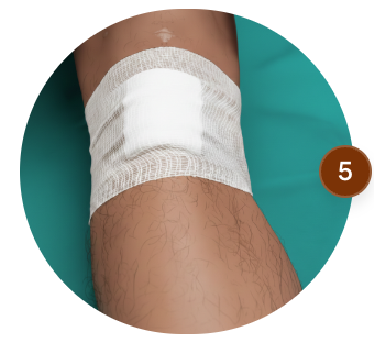 Venous Ulcers