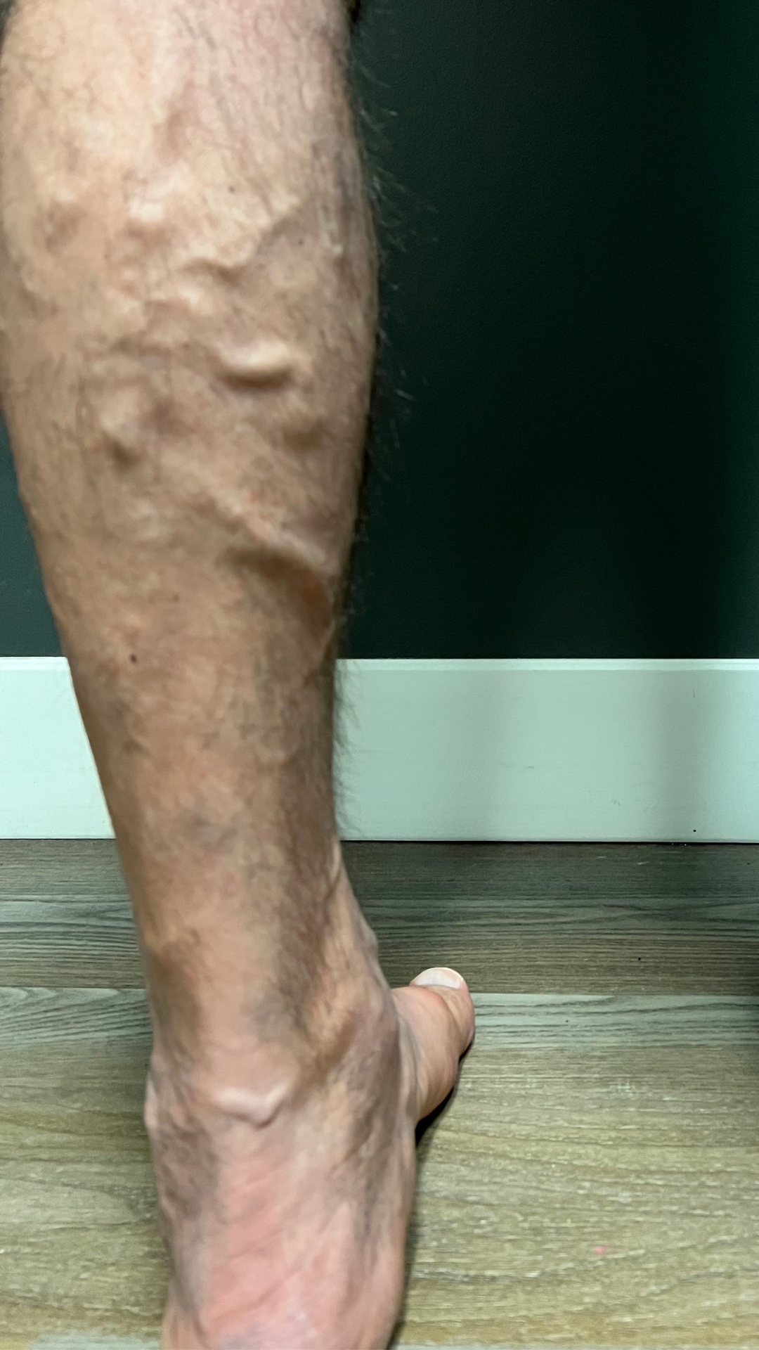 Varicose Veins In Legs Before Treatments