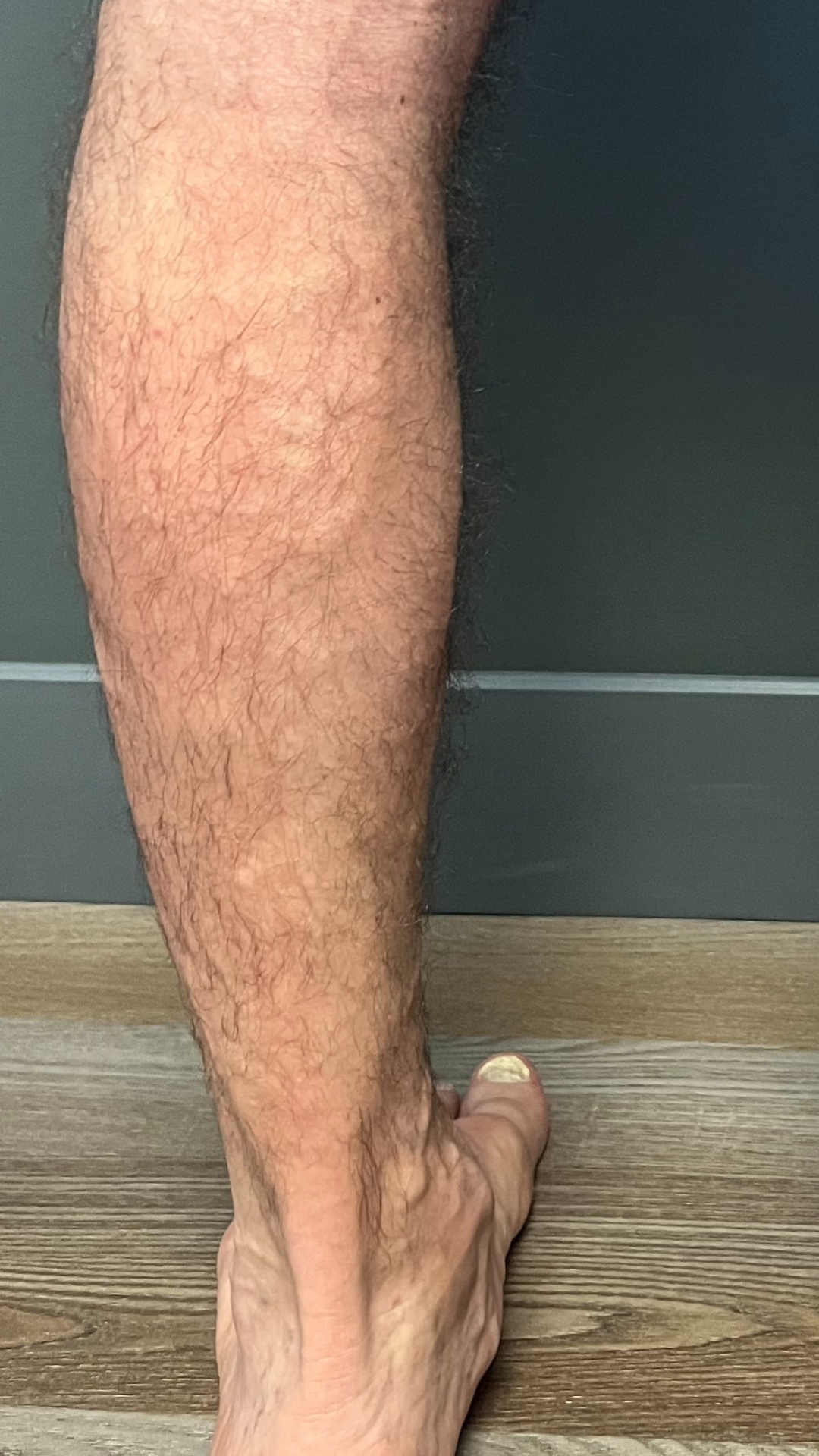 Varicose Veins In Legs After Treatment