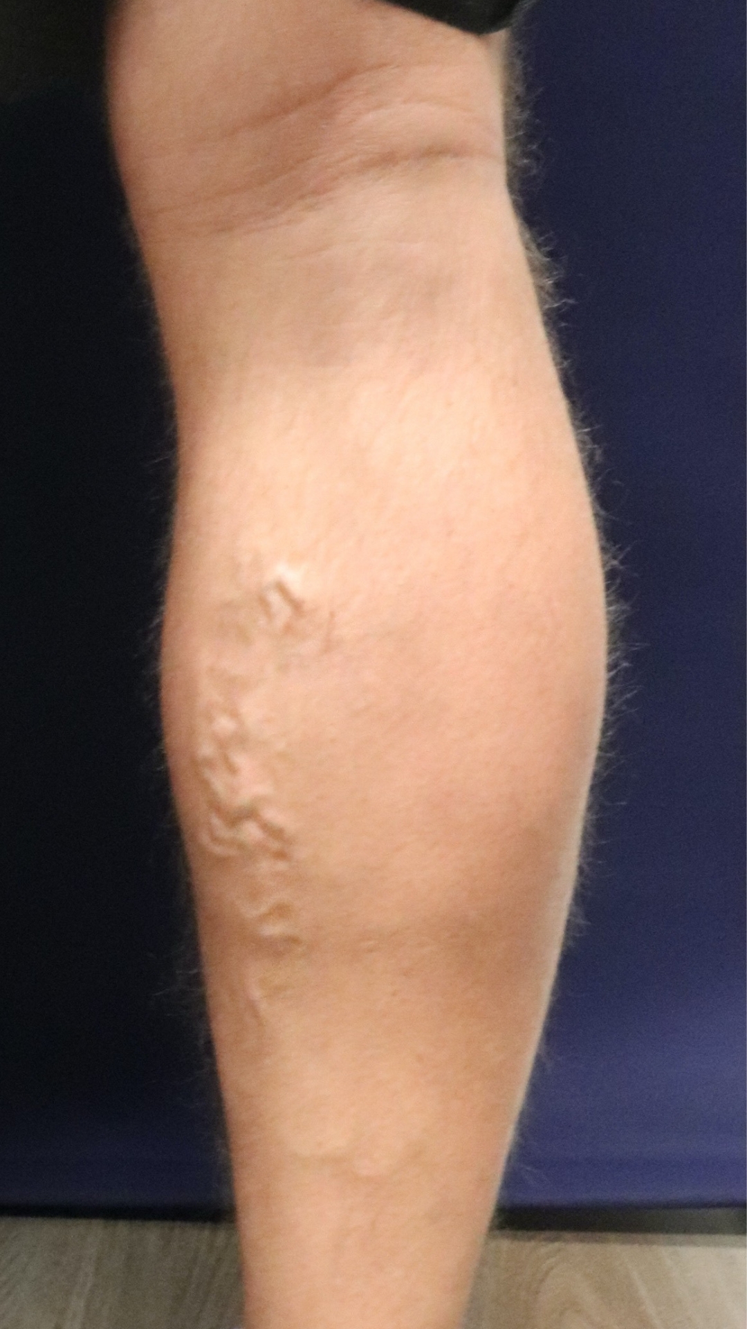 Varicose Vein in Leg