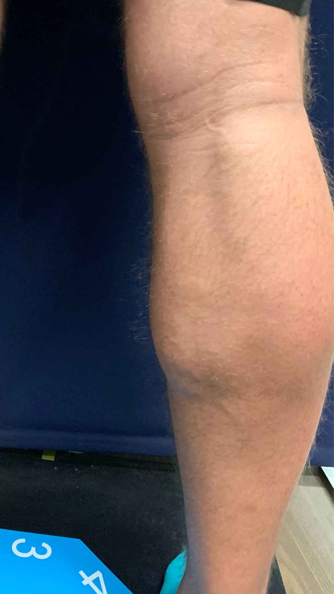 Varicose Vein in Leg After Getting Treatment