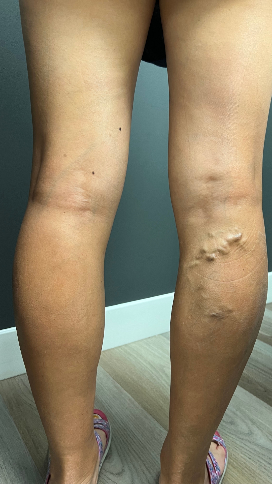 Bulging Veins in Leg Before Treatment
