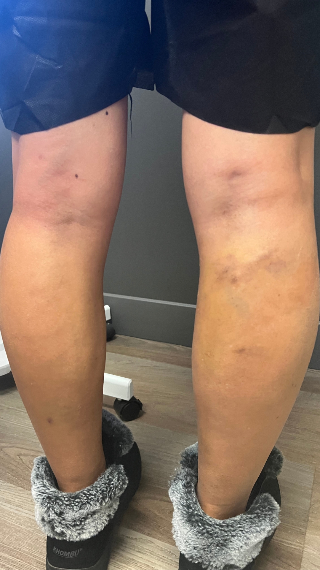 Bulging Veins in Leg After Treatment