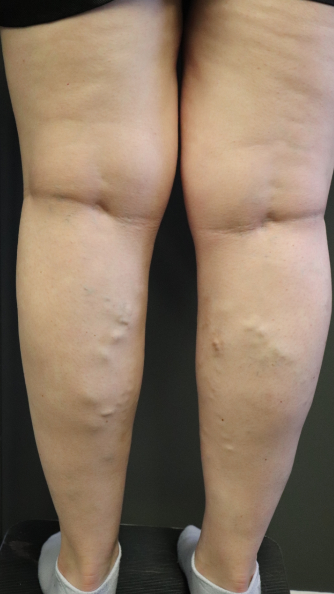 Varicose Veins Before Treatment