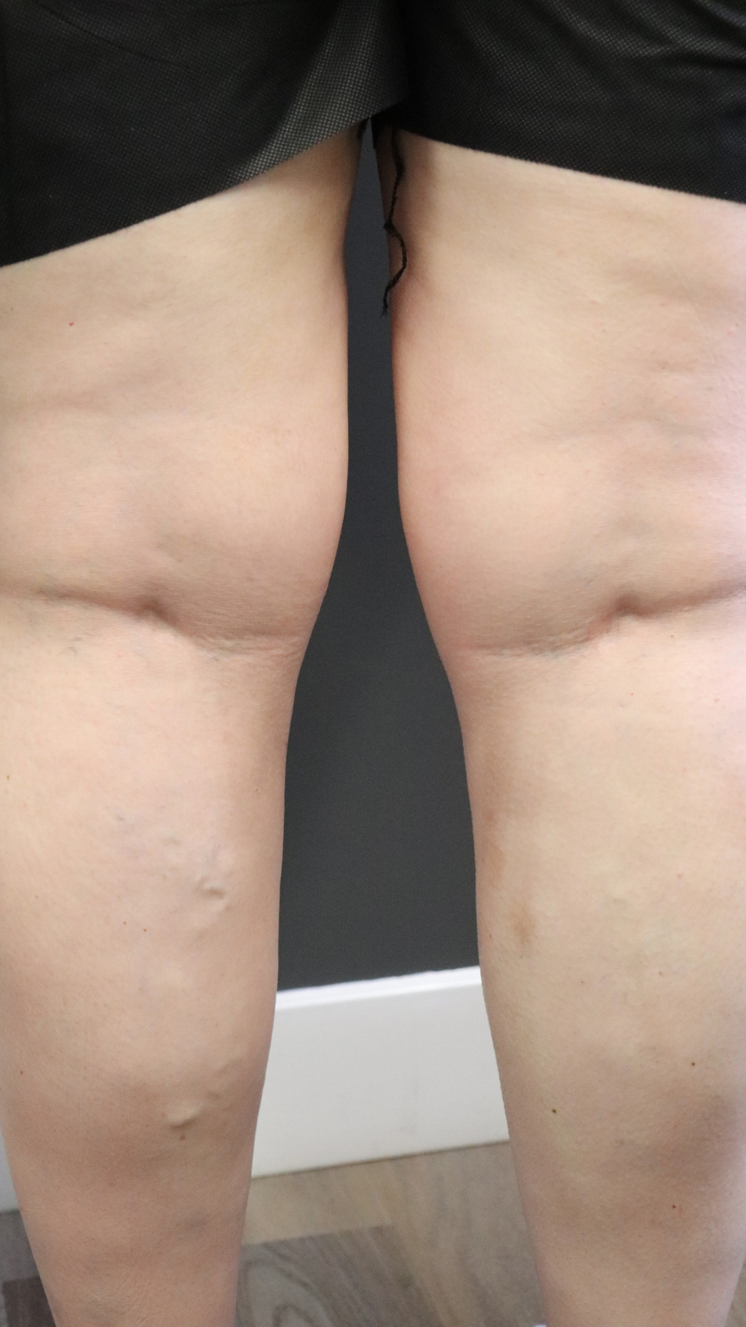 Varicose Veins After Treatment