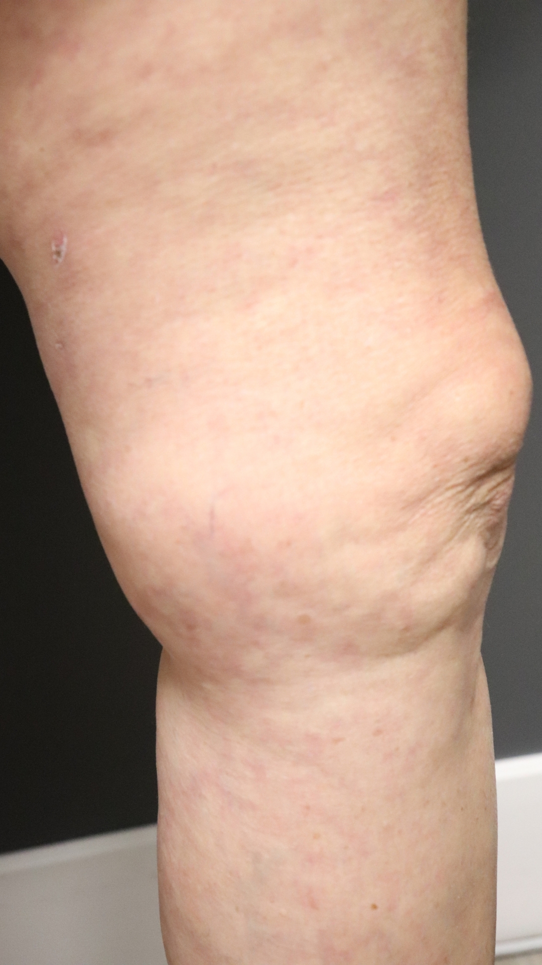 A leg after spider vein treatment