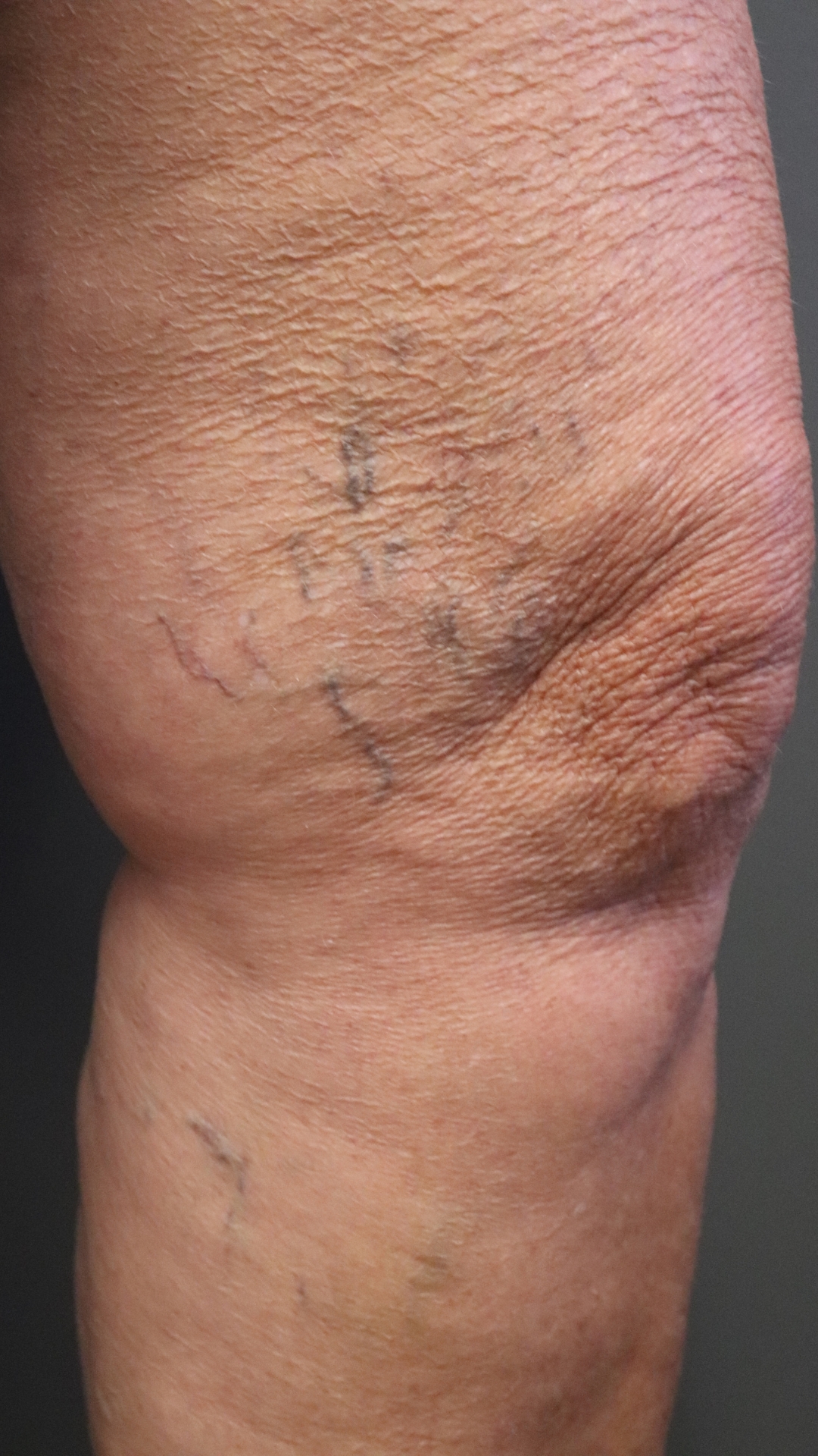 A leg with spider veins before treatment