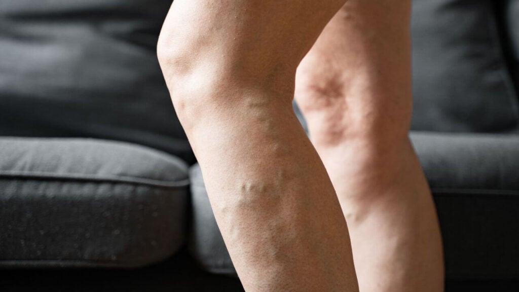 Bulging veins