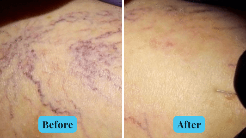 Spider vein before and after treatment