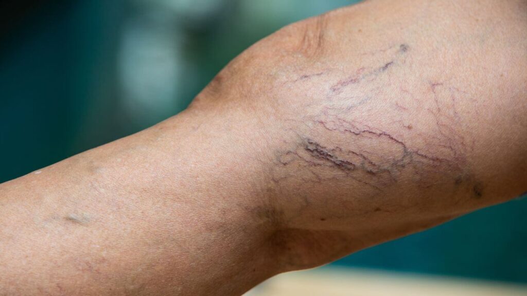 A leg that has spider veins