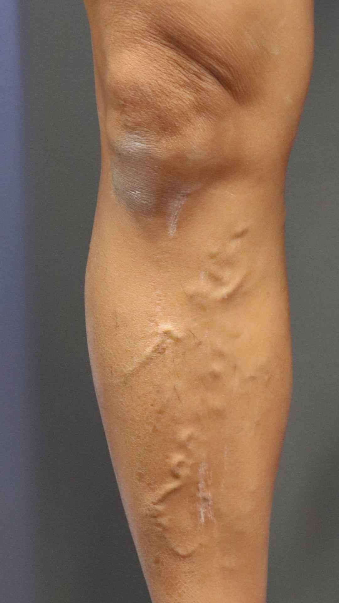 A Leg Varicose Veins Before Treatment Photo