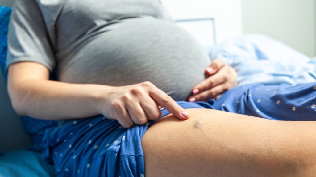 A pregnant woman with varicose veins