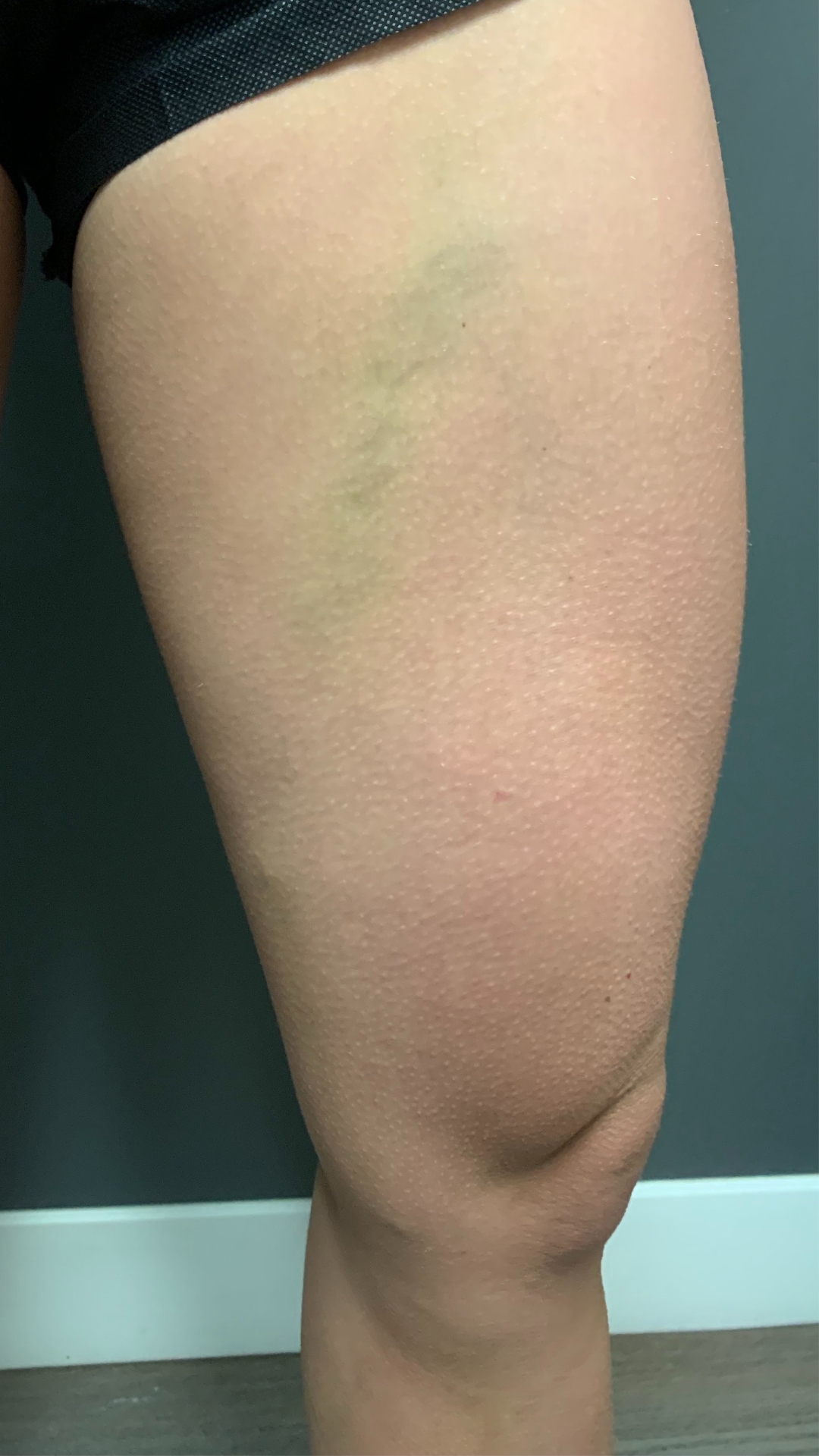 Cosmetic spider vein before treatment
