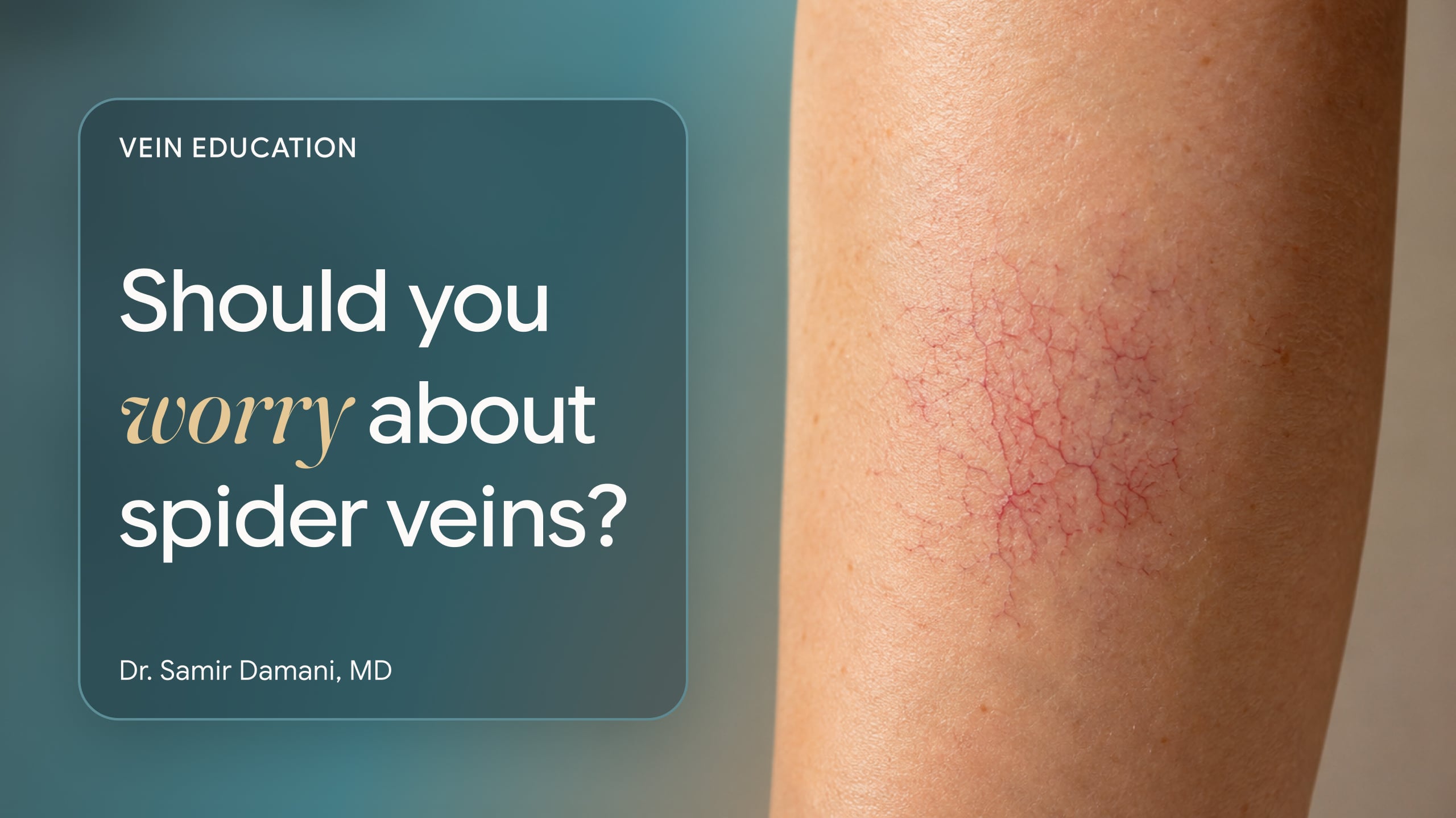 Spider Veins Explanation