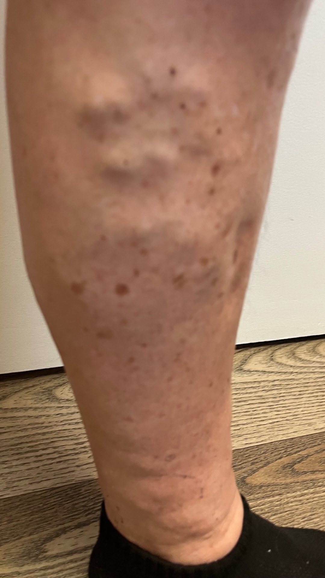Bulging Veins Before Treatment