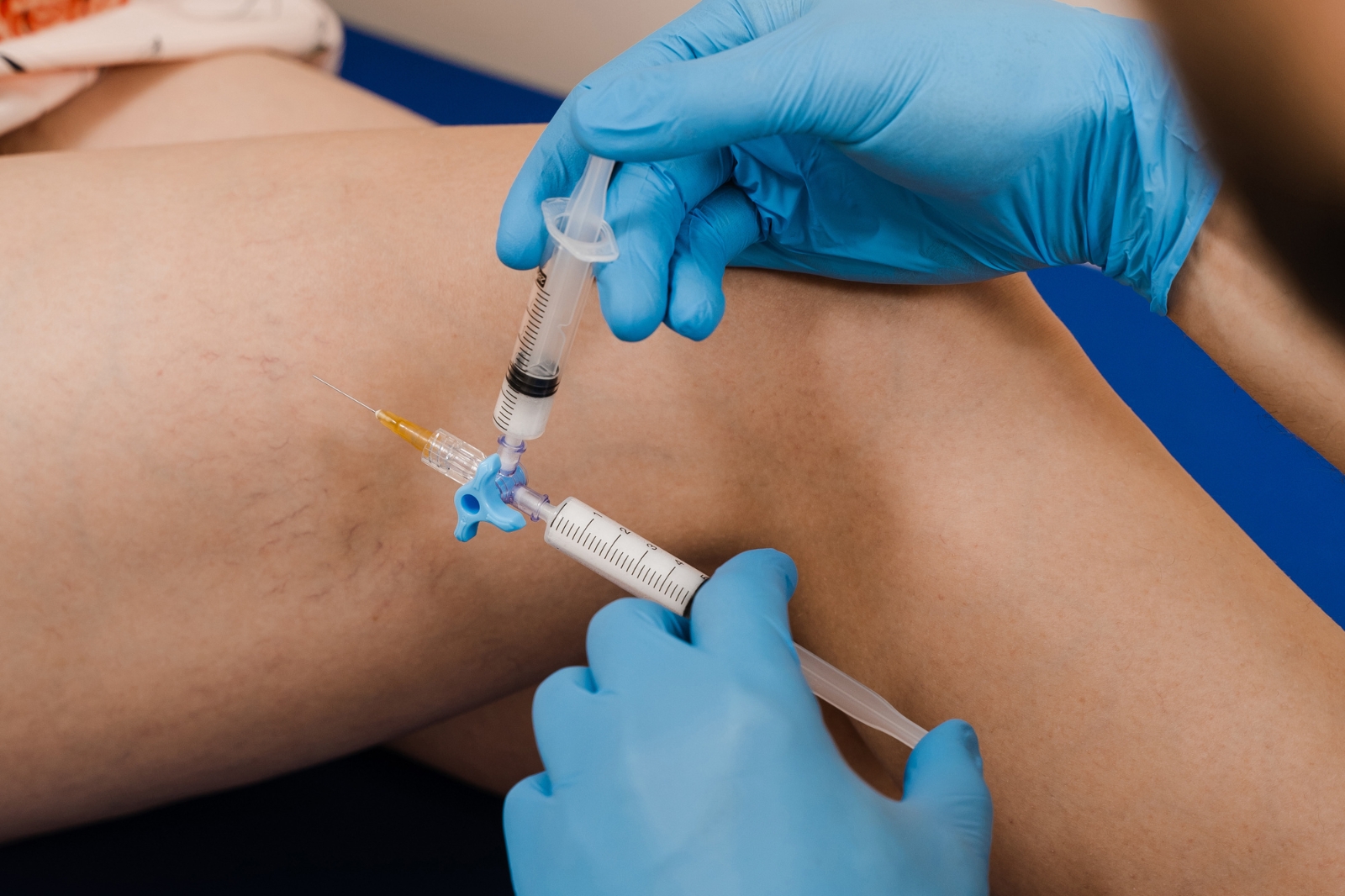Sclerotherapy cost for spider veins