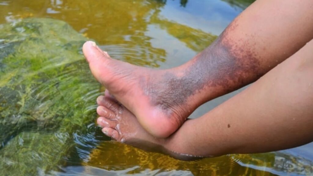 Skin-Discoloration