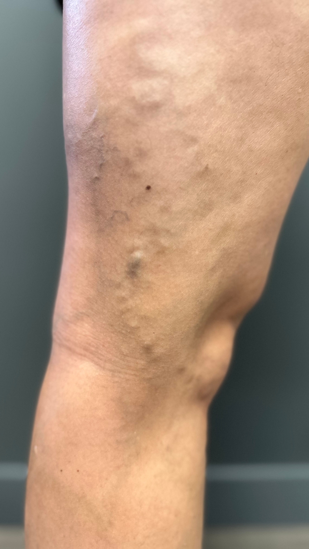 Spider Vein After Treatment