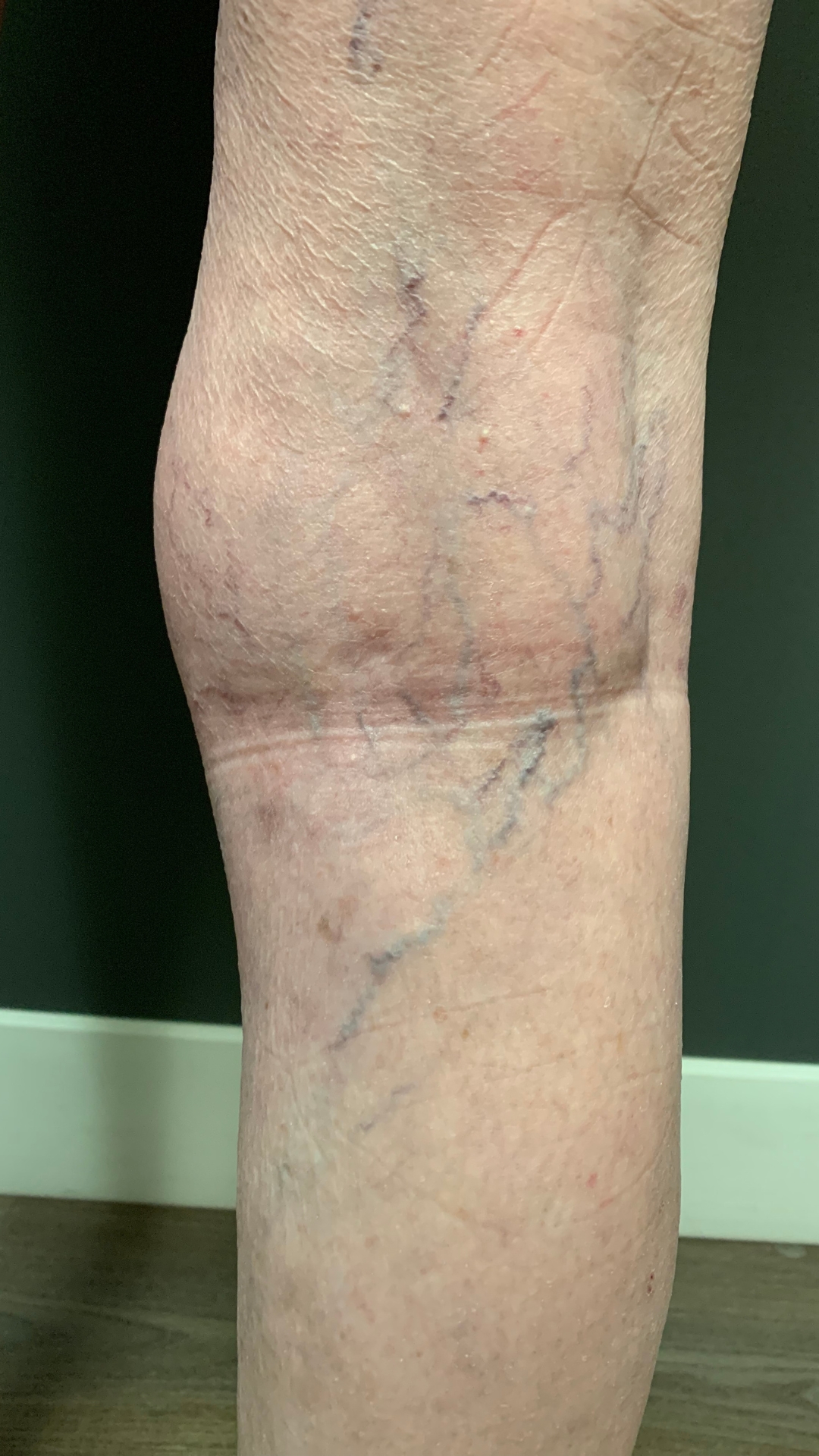 Spider Vein Before Treatments