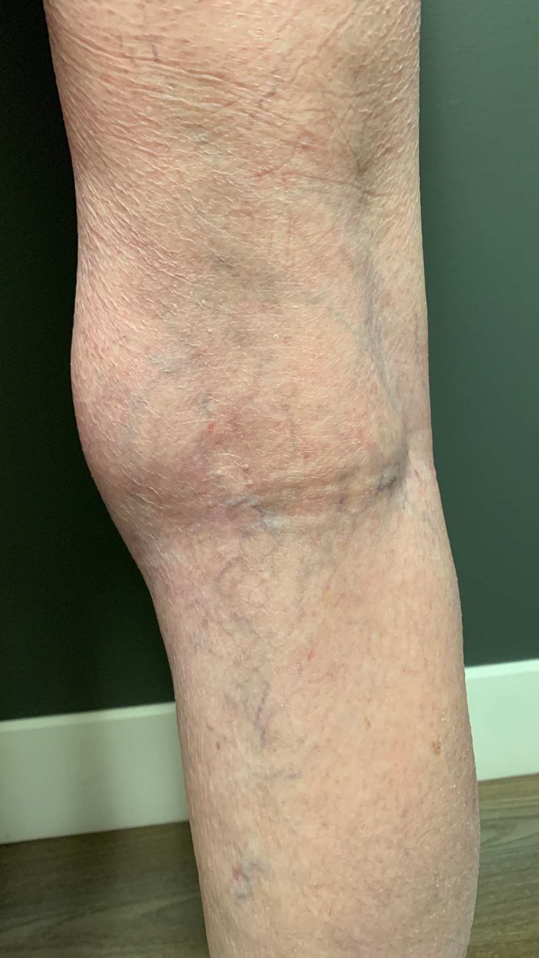 Spider Veins After Treatments