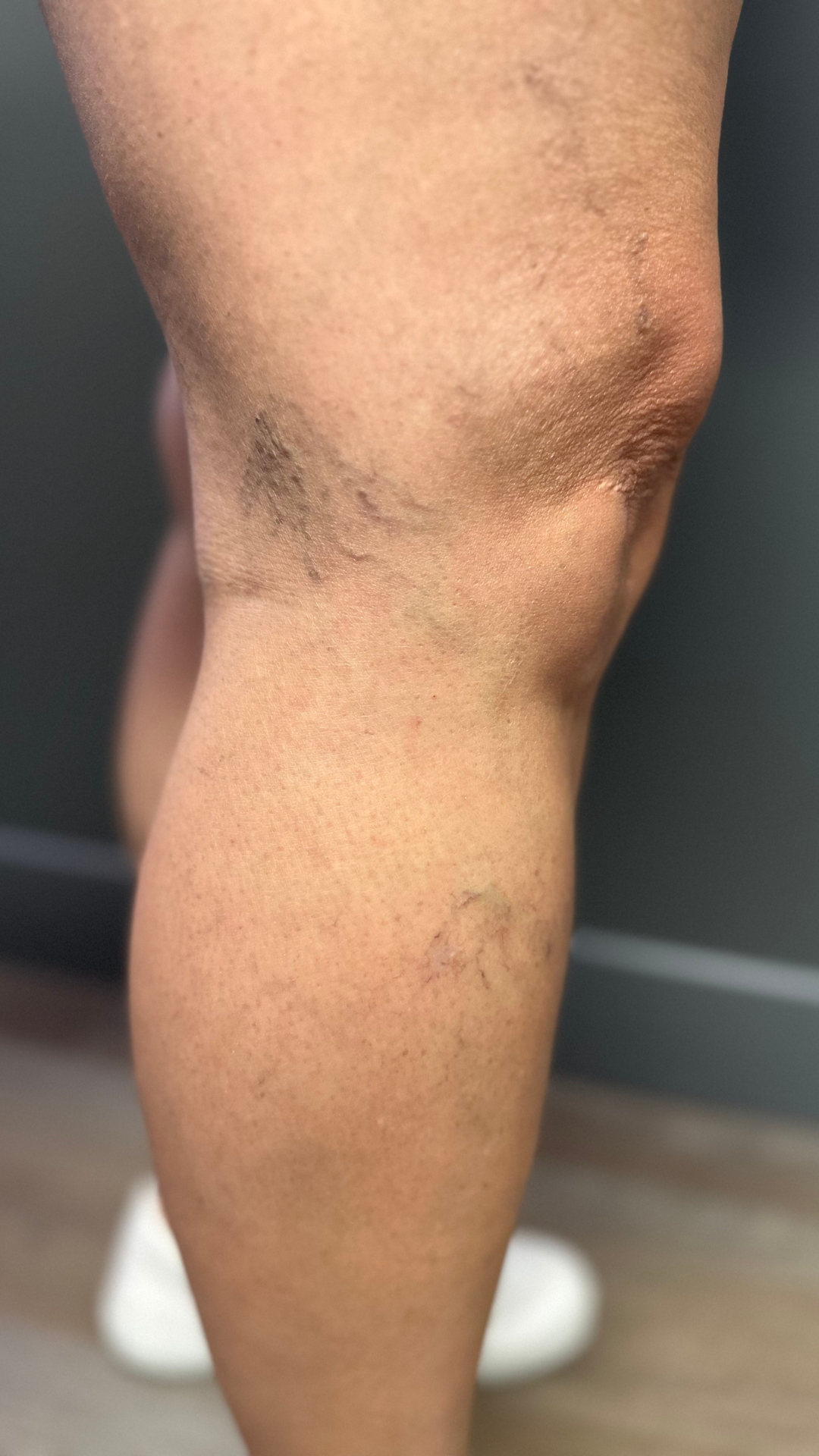 Spider Veins In Ankle After Treatment