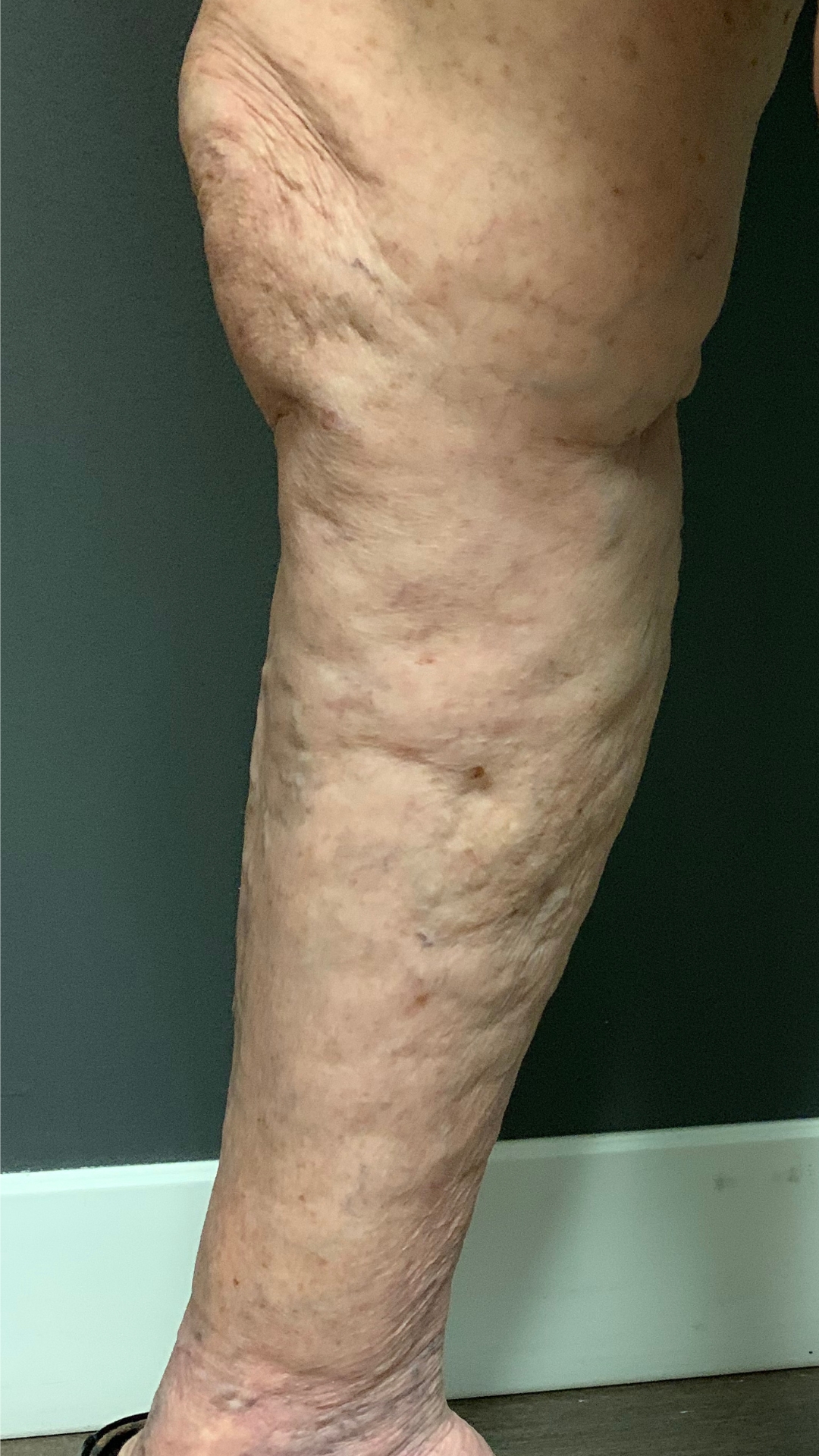 Varicose & Spider Veins After Treatment