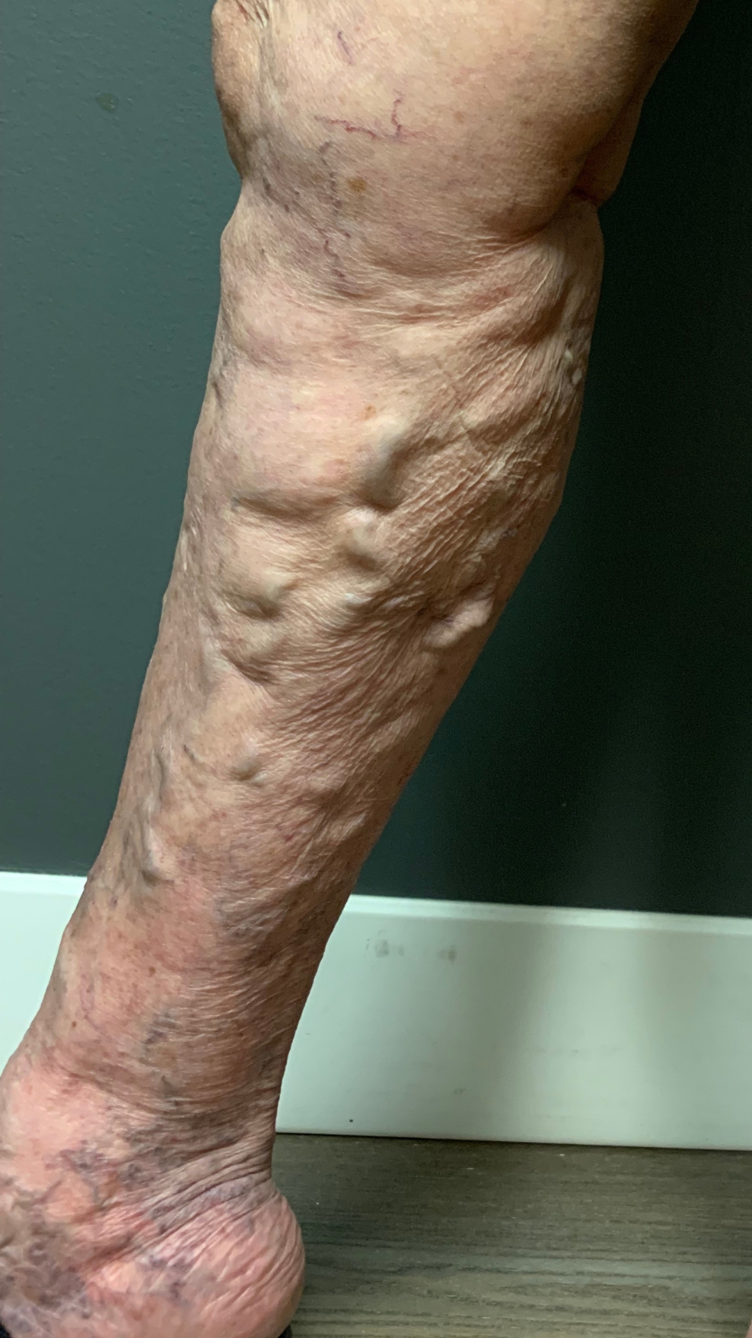 Varicose & Spider Veins Before Treatment