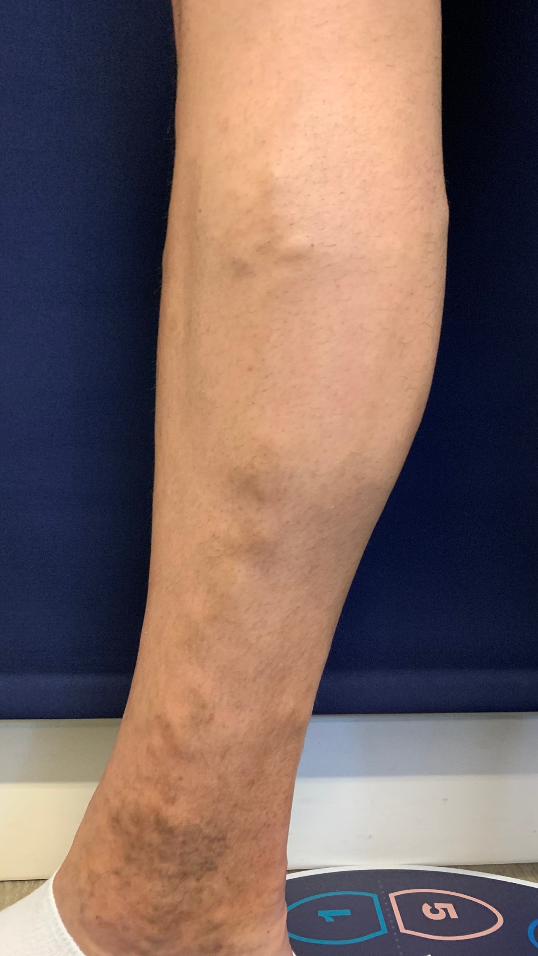 Varicose Vein Leg Before Treatment