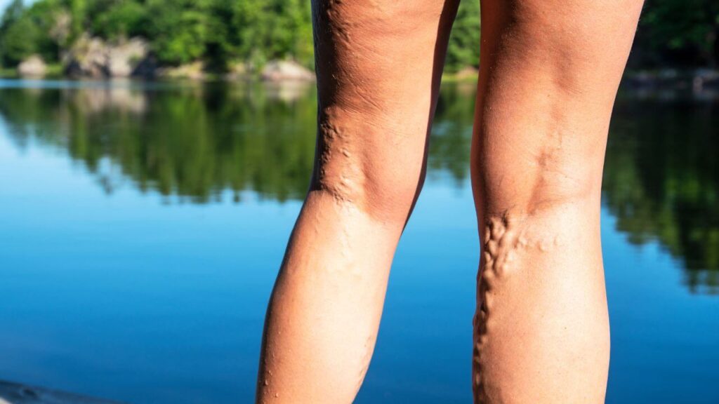 Varicose Veins in Legs