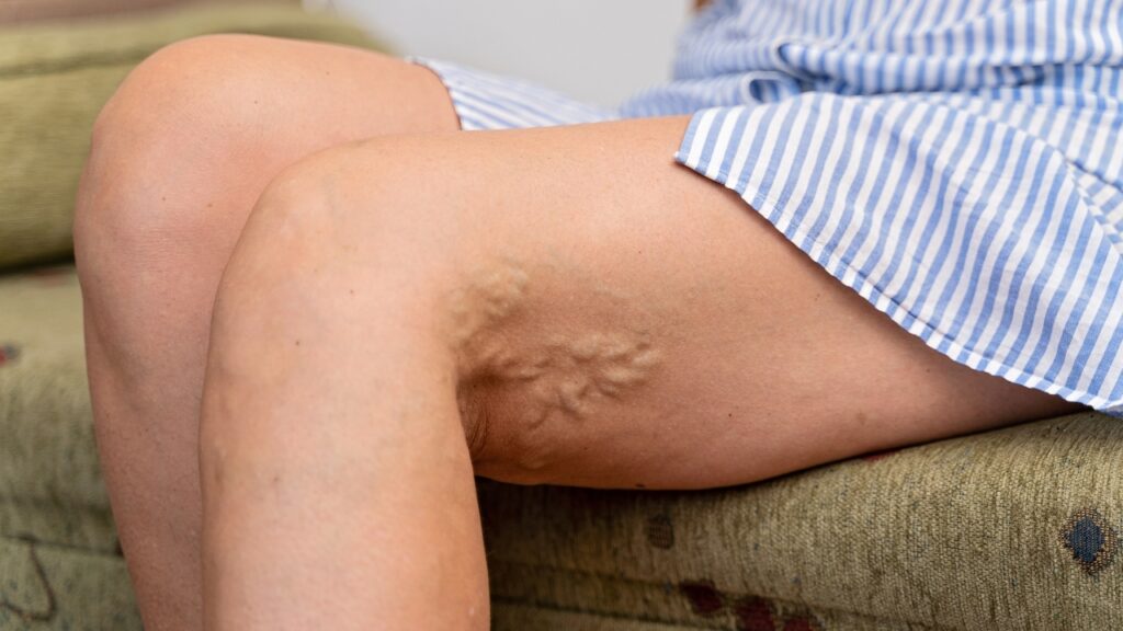 Varicose veins