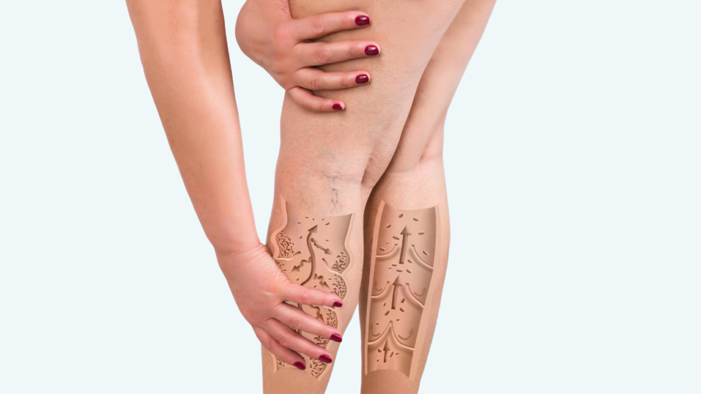 Vein Disease Illustration