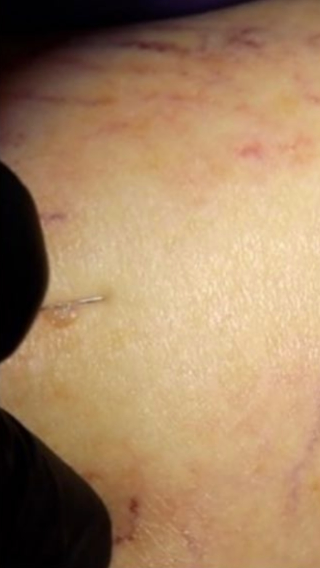 Spider Vein Removal After Photos