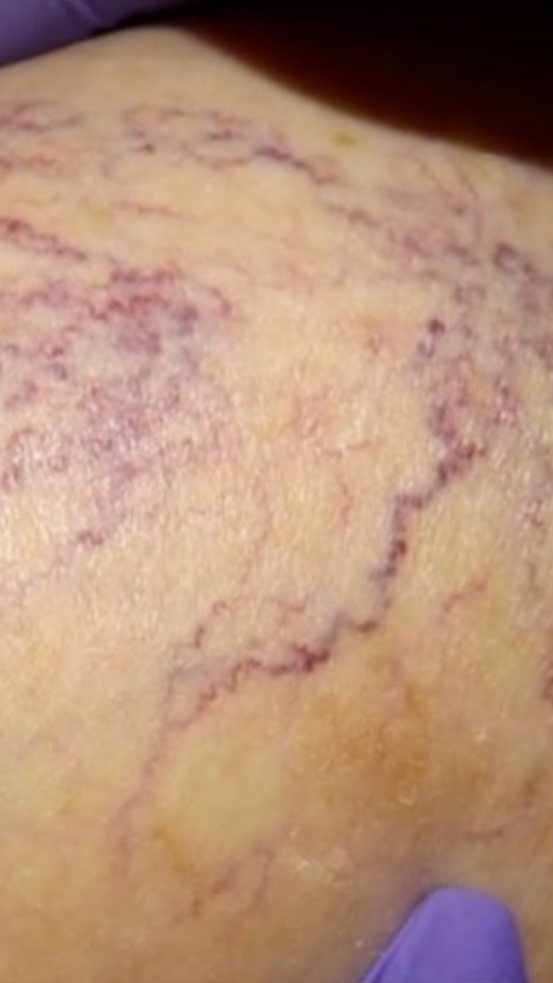 Spider Vein Removal Before Photos