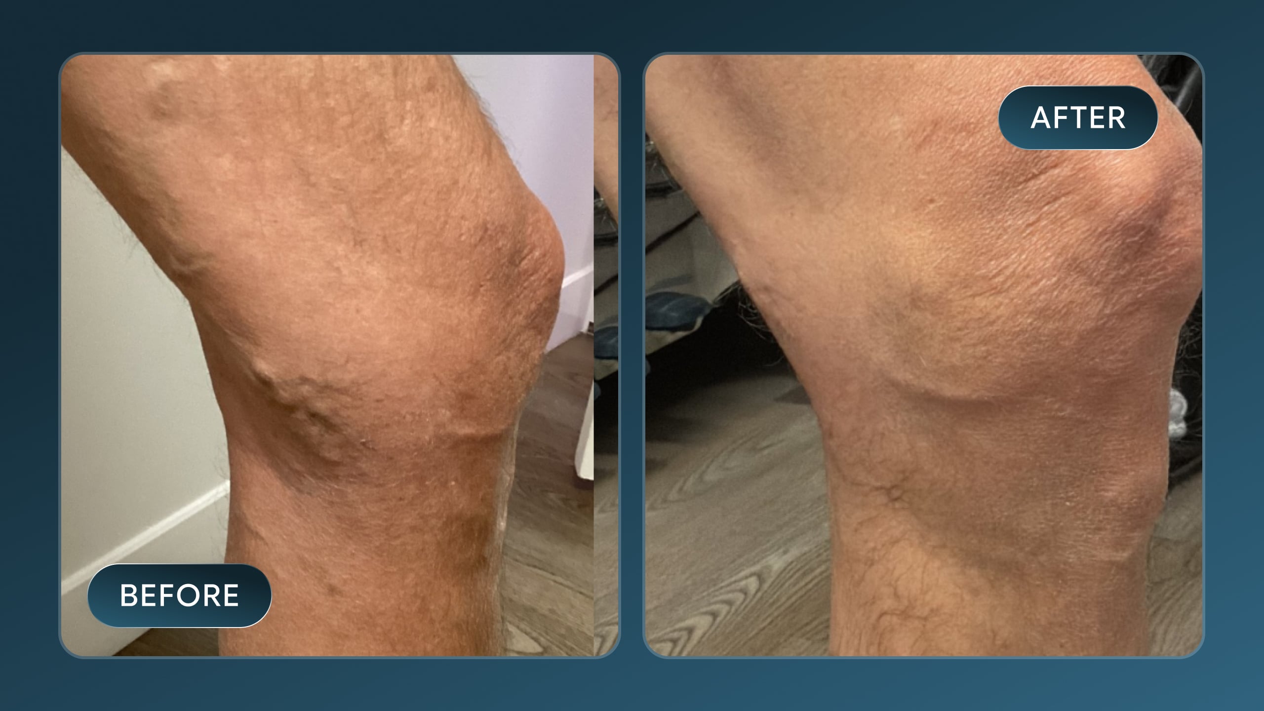 Vein Treatment Before After Result