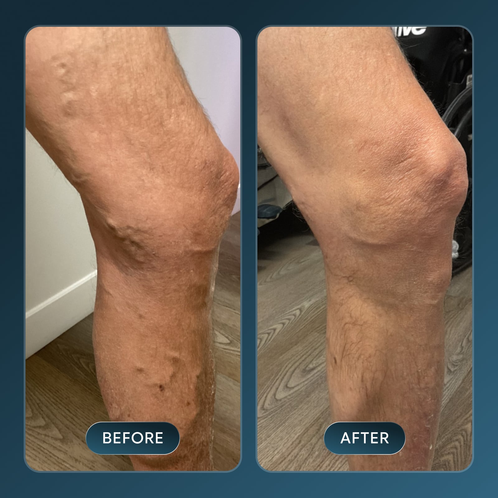 Vein Treatment Before and After Results