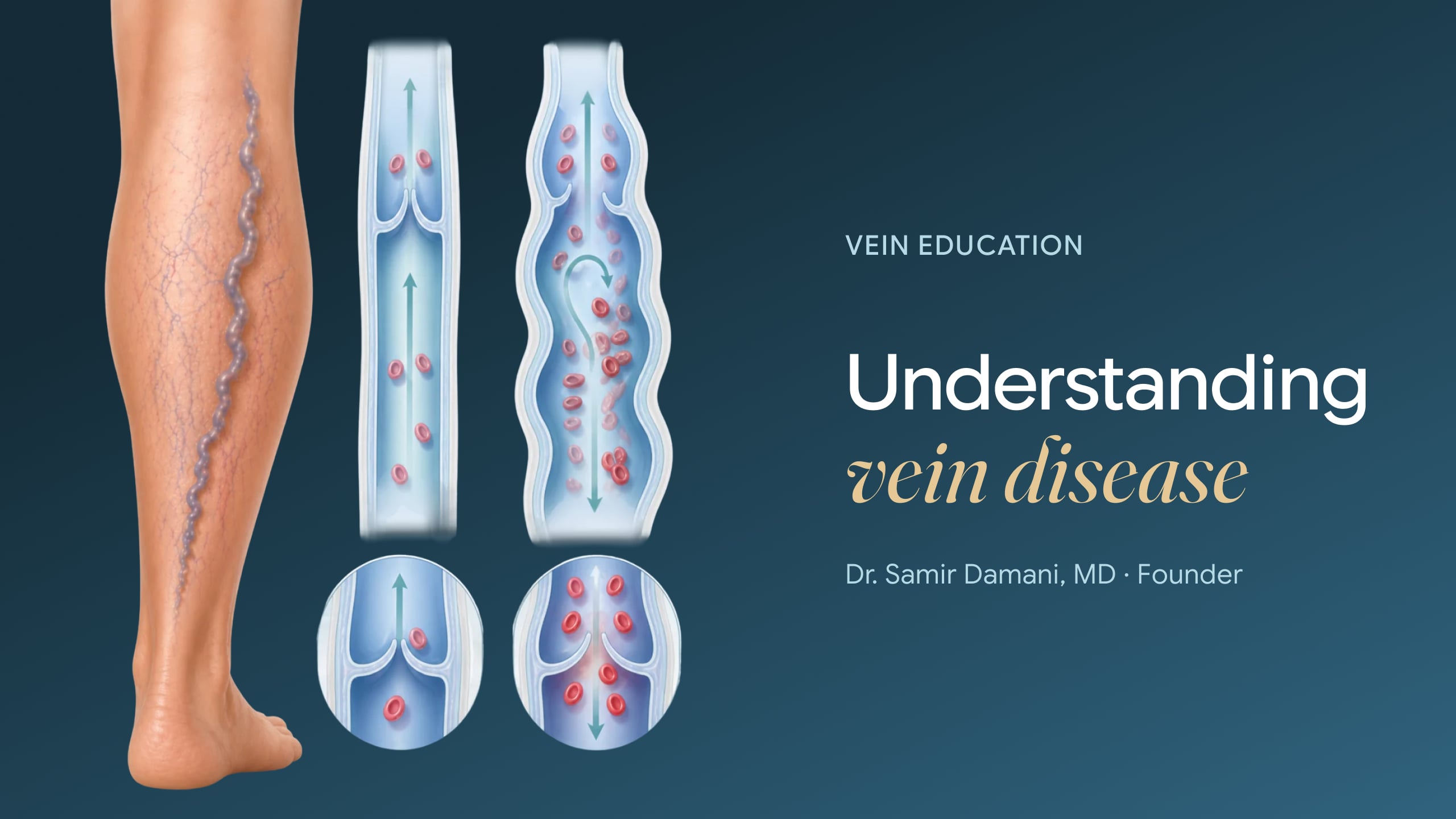 Vein Disease Illustration