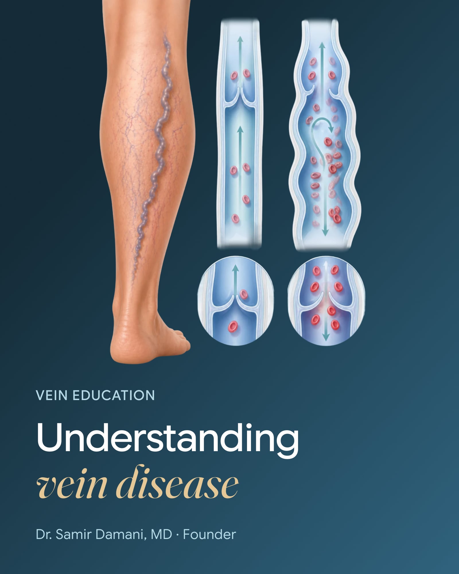 What is Vein Disease