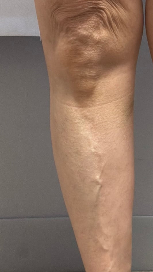 Back of the calf after varicose vein treatment