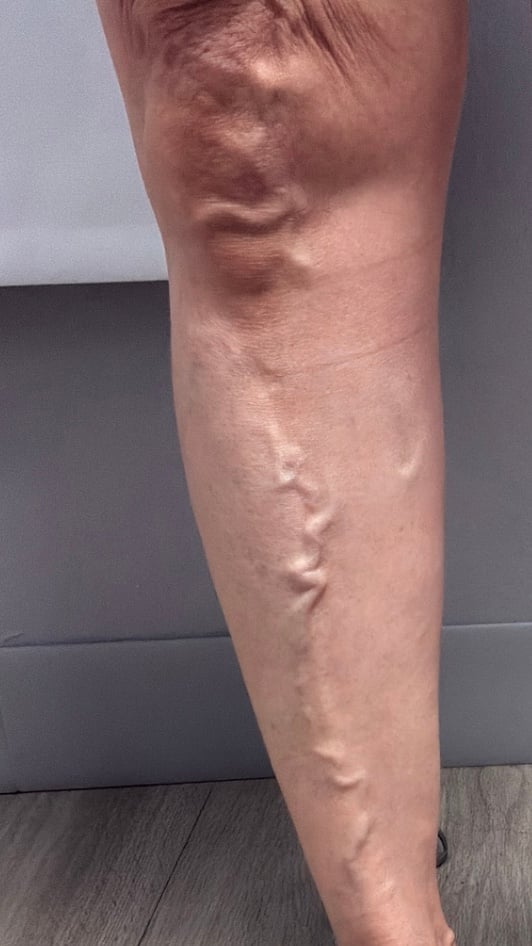 Varicose veins on the back of the calf before treatment