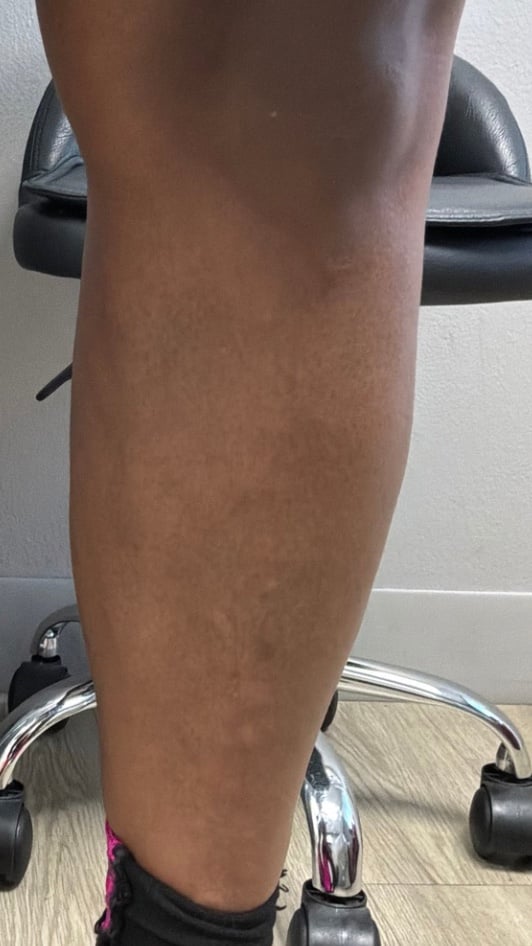 Calf after varicose vein treatment