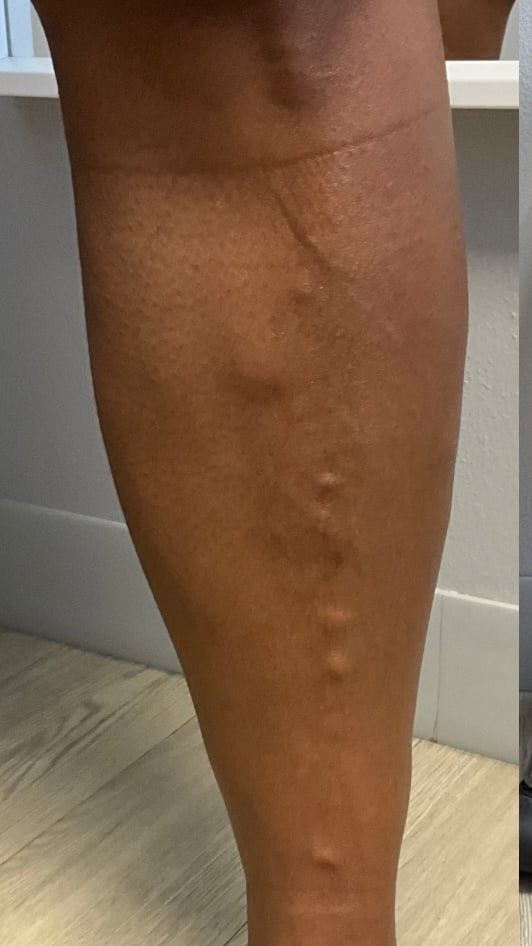 Bulging varicose veins on the calf before treatment